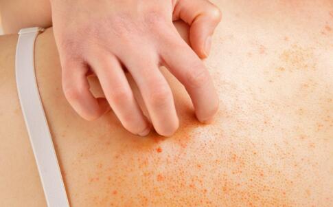 中藥祛痘配方有哪些?你不知道的還有很多