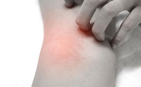 皮膚黑色素沉淀怎么辦 要如何趕走黑色素