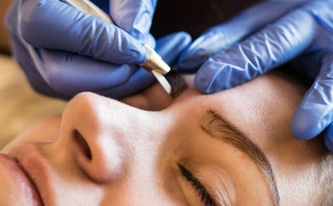 激光去黑色素效果如何 無痕見效快