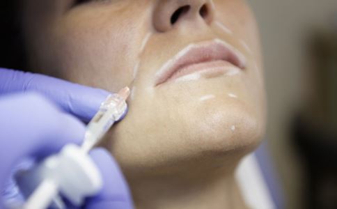 激光去黑色素效果如何 療效確切無(wú)損傷