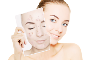 安全有效的祛痘方法