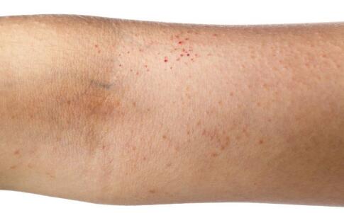 戰(zhàn)“痘”小秘密