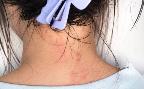 電波拉皮有哪三大特色 除皺效果立竿見(jiàn)影